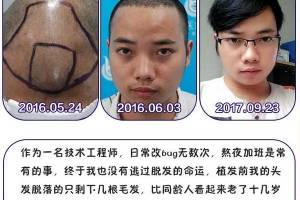 黑龙江瑞丽植发中心植发怎么样附全新植发价格表(价目表)