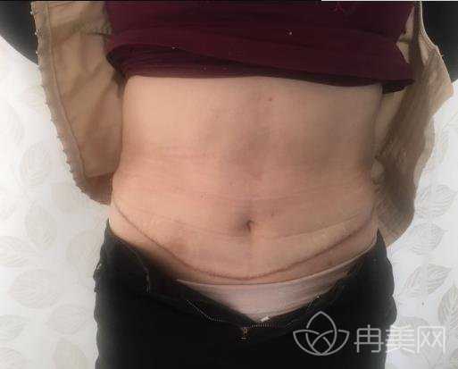 慕名去无锡同济整形做了祛疤,肚子上难看的疤痕不见了