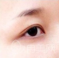 自体脂肪丰眉弓