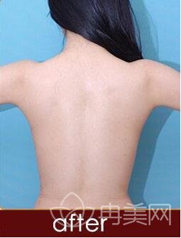 吸脂瘦后背