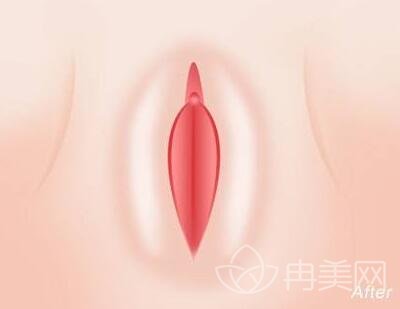 阴唇整形