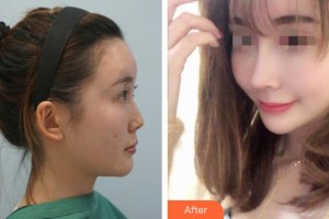 平顶山艺美医疗美容医院于亮整形价格表附肋软骨隆鼻案例展示