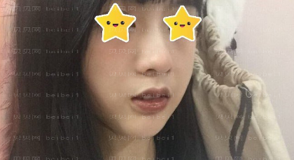 西京医院整形科张曦唇部整形介绍片较新分享_如今的嘴唇,看起来性感很多了哦