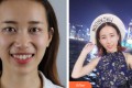 重庆医科大学附属第二医院数字口腔中心向征整形价格表附牙齿矫正案例果