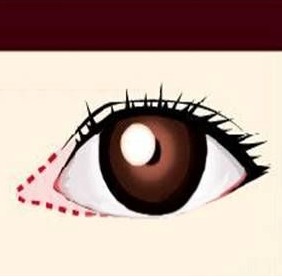 开眼角手术眼部整形