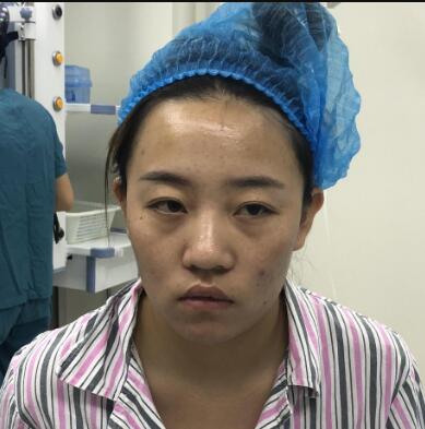 郑州华领医疗美容医院如何拥有精致妈生鼻？附 案例如何保证术后美观和触感真
