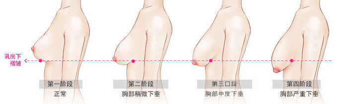 胸部下垂怎么办?该怎么矫正?