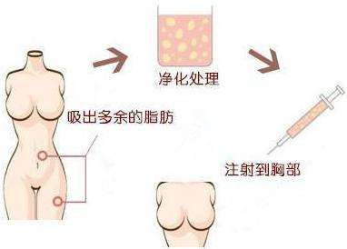 脂肪隆胸刚做完,一减肥胸就没了?
