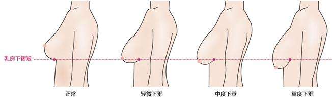 乳房下垂应该怎么办?