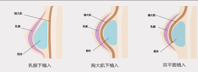 北京雅韵整形医院假体隆胸多少钱?