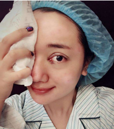 双眼皮术后常见的三个问题,看看你是不是想要