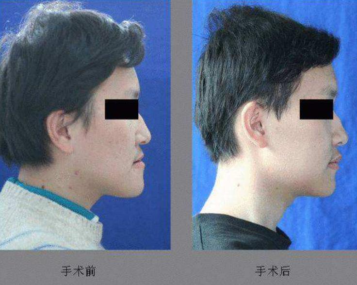 地包天要如何矫正?几岁矫正*好?