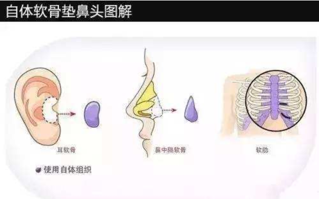 自体软骨隆鼻与假体隆鼻的区别有哪些方面?