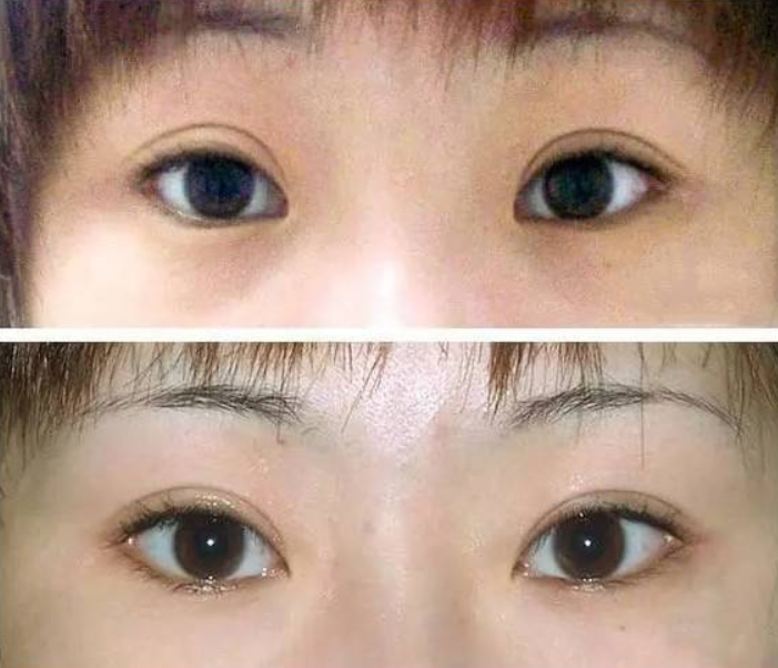 开眼角后疤痕增生可以修复吗?