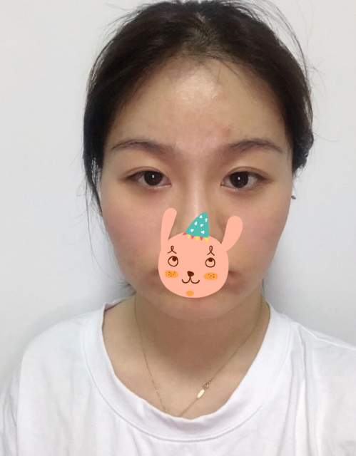 在南京友谊医院做的下颌角切除,*果很好