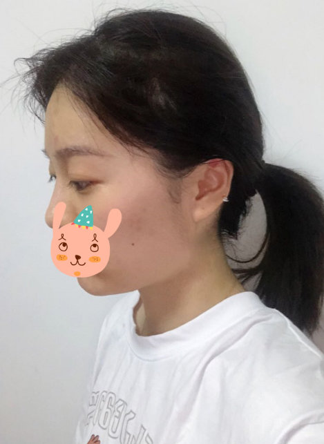在南京友谊医院做的下颌角切除,*果很好
