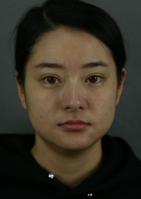 在上海首尔丽格做的磨骨,术后50天的*果