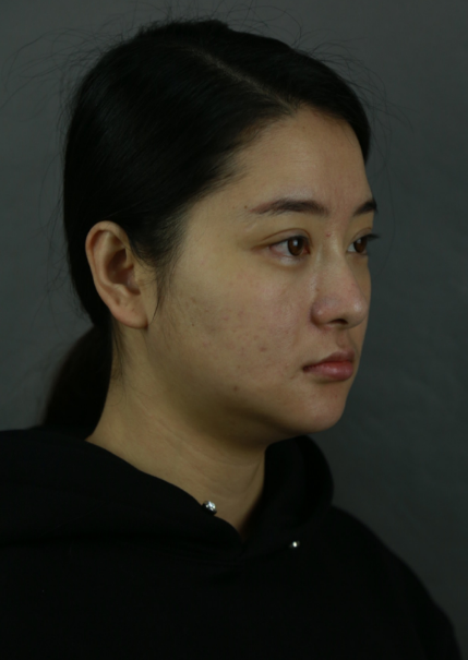 在上海首尔丽格做的磨骨,术后50天的*果