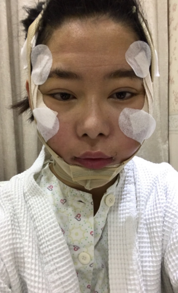 在上海首尔丽格做的磨骨,术后50天的*果
