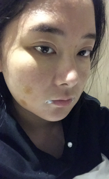 在上海首尔丽格做的磨骨,术后50天的*果
