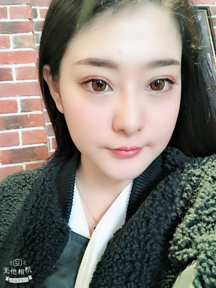 在上海首尔丽格做的磨骨,术后50天的*果