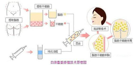 自体脂肪填充容易被吸收、移位吗?