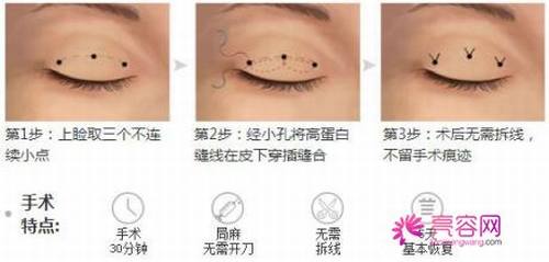 你想做双眼皮吗?埋线双眼皮手术果自然吗?小编给你科普科普埋线双眼皮知识!