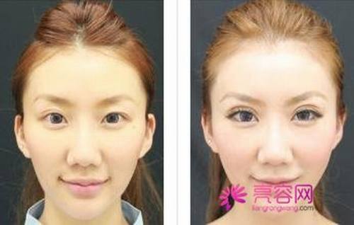 你想做双眼皮吗?埋线双眼皮手术果自然吗?小编给你科普科普埋线双眼皮知识!
