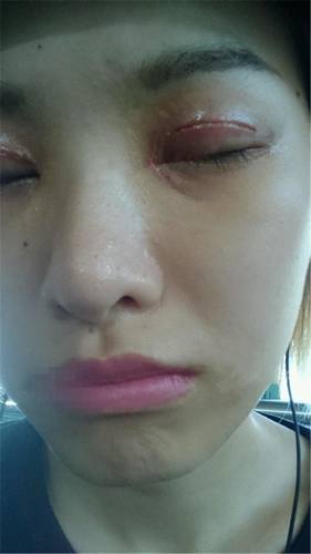 给你们看看我的双眼皮案例,真的变得好漂亮啦!!!不看后悔呦