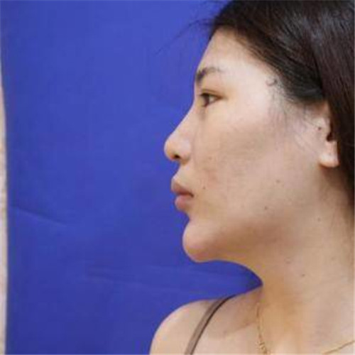 上海华美李健隆鼻怎么样?案例_价格_口碑