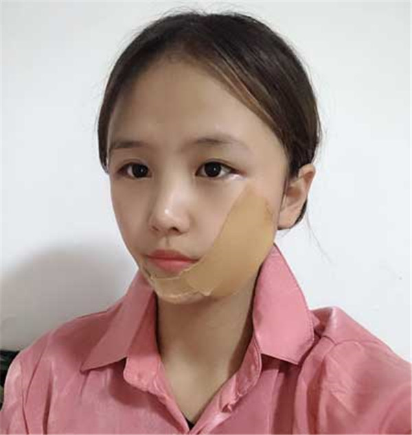 上海华美李健抽脂术后果怎么样?案例_价格