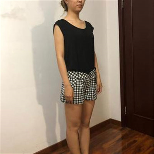 北京东方和谐王自谦抽脂术后果怎么样?案例,价格,口碑