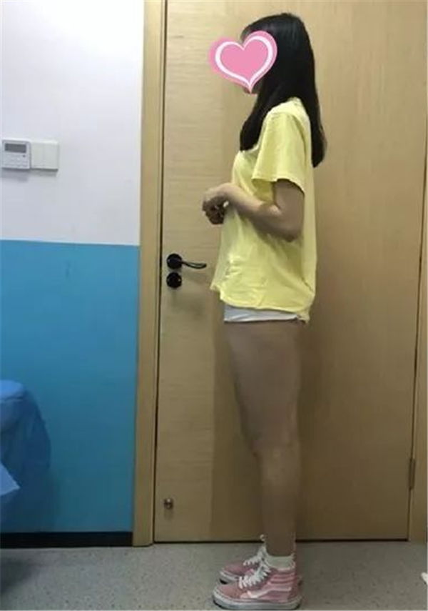 北京东方和谐孙泽芳抽脂术后果怎么样?案例_价格_口碑
