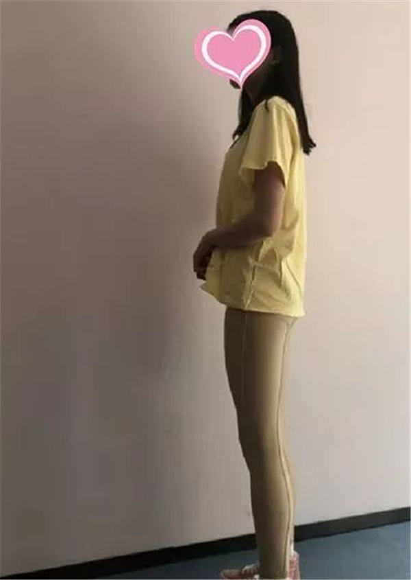 北京东方和谐孙泽芳抽脂术后果怎么样?案例_价格_口碑