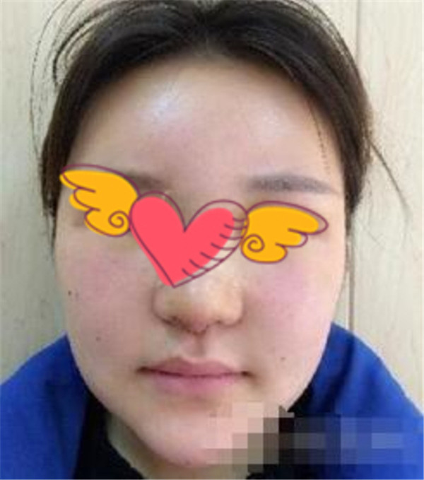 北京上上相郑楚蓉抽脂术后果怎么样?案例,价格,口碑