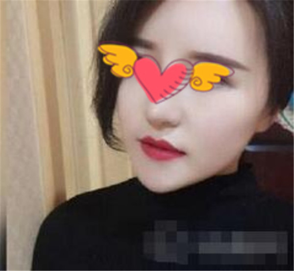北京上上相郑楚蓉抽脂术后果怎么样?案例,价格,口碑
