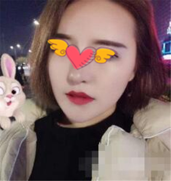 北京上上相郑楚蓉抽脂术后果怎么样?案例,价格,口碑
