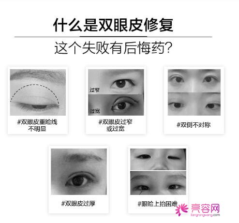 朱晓峰和潘贰谁修复双眼皮更好些？内附两位医生信息介绍