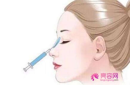 伊维兰注射隆鼻果怎么样呢？附上我的真实经历分享！【注射隆鼻案例】