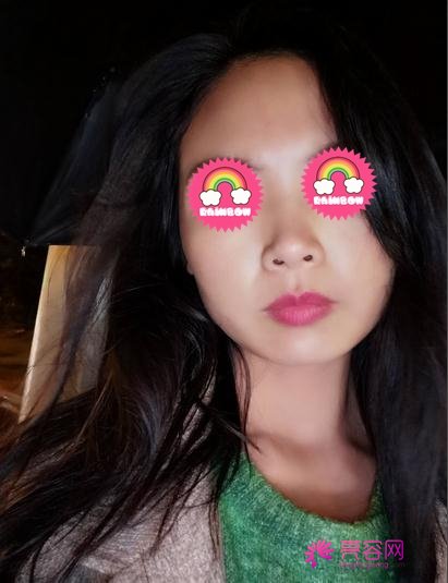 师俊莉做鼻子的案例,术后的我终于变漂亮了!短短3个月就拥有美鼻!