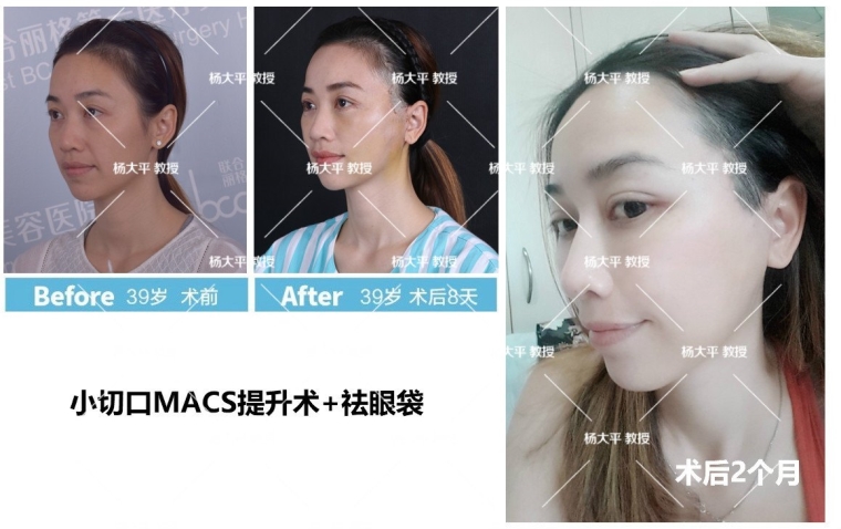 细致讲解假体垫下巴恢复期要多久