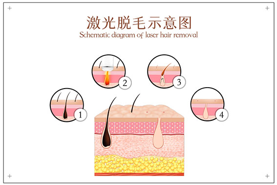 摄图网_401803180_banner_激光脱毛示意图（非企业商用）.jpg