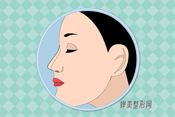 隆鼻的方法有哪些？隆鼻后多久能恢复？