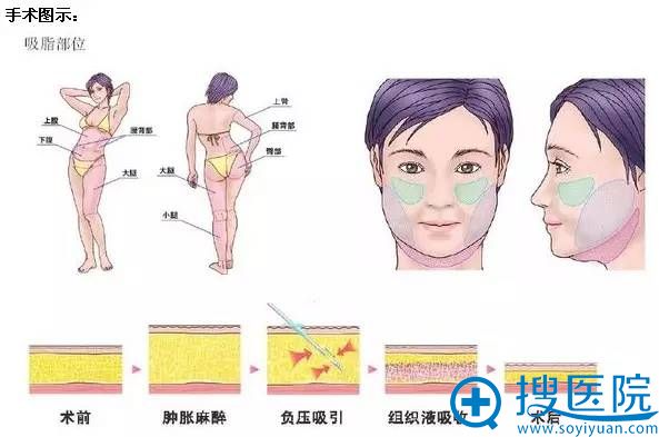 吸脂手术示意图 吸脂手术示意图