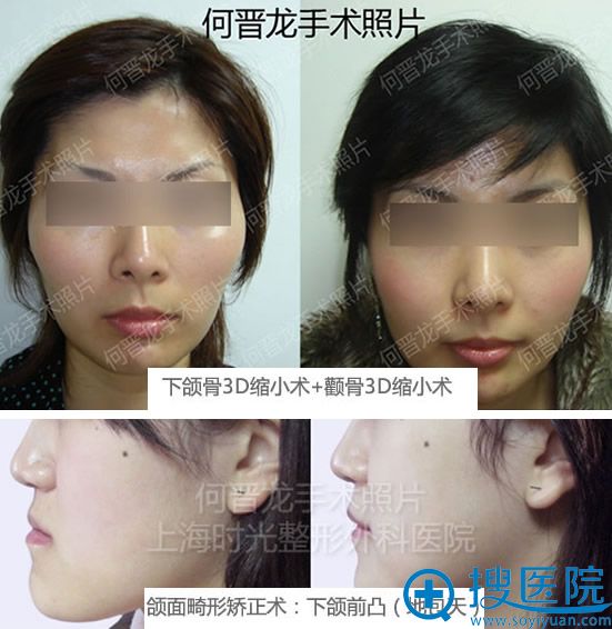 何晋龙下颌角颧骨成功手术照片 何晋龙下颌角颧骨成功手术照片