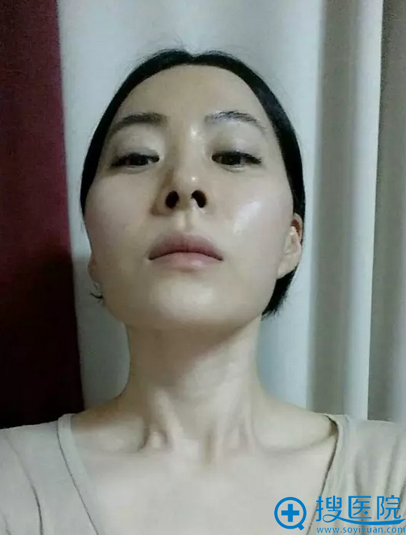 美妞术前仰视照 美妞术前仰视照