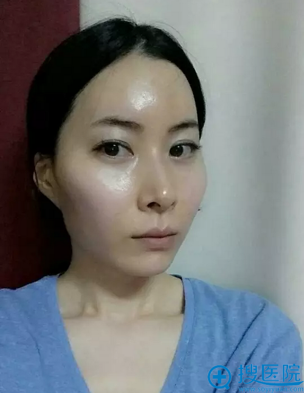 美妞术前照 美妞术前照