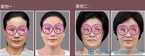 拉皮手术案例 拉皮手术案例