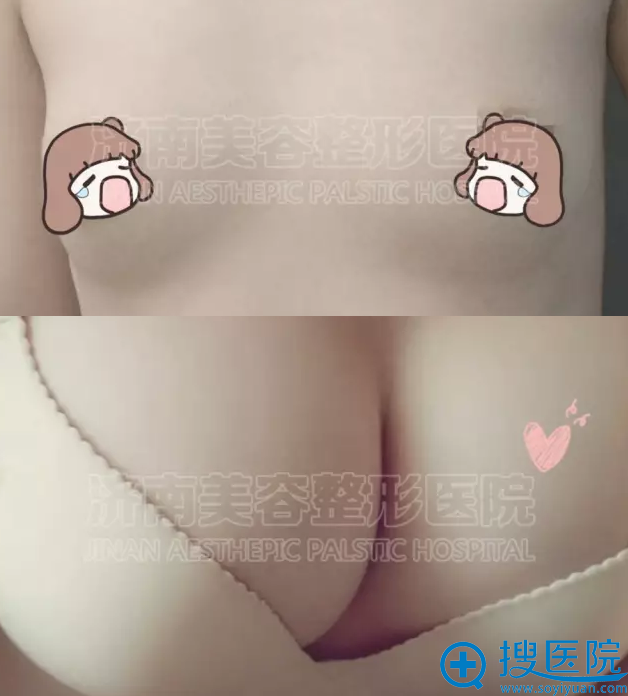 济南美容整形医院宝俪假体真人案例 济南美容整形医院宝俪假体真人案例