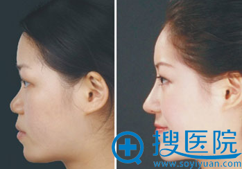 隆鼻尖案例对比图 隆鼻尖案例对比图